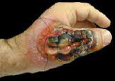 Steek van een schorpioen.